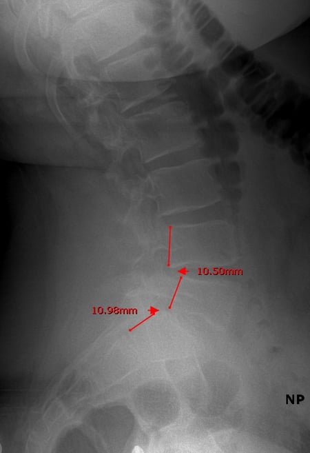 Dr Lazar Lateral Lumbar Xray